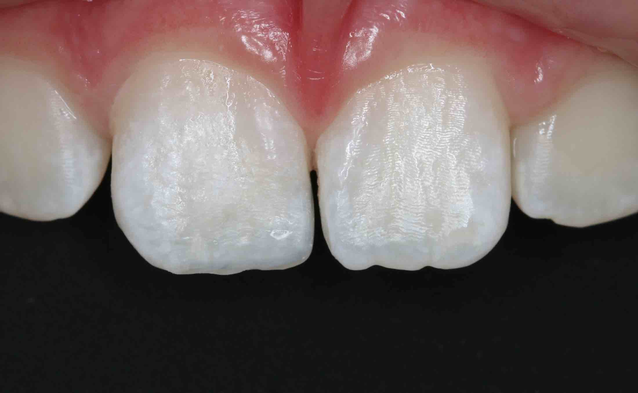 Front fracture tooth solution(After)